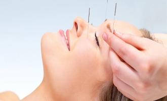 Acupuncture