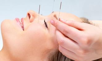 Acupunture 